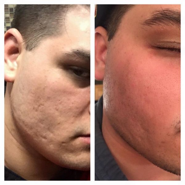 24212 Аппарат алмазной дермабразии Nova NewFace NV-108 (2 в 1) Nova NewFace (НОВА НьюФейс)  - Вид №7