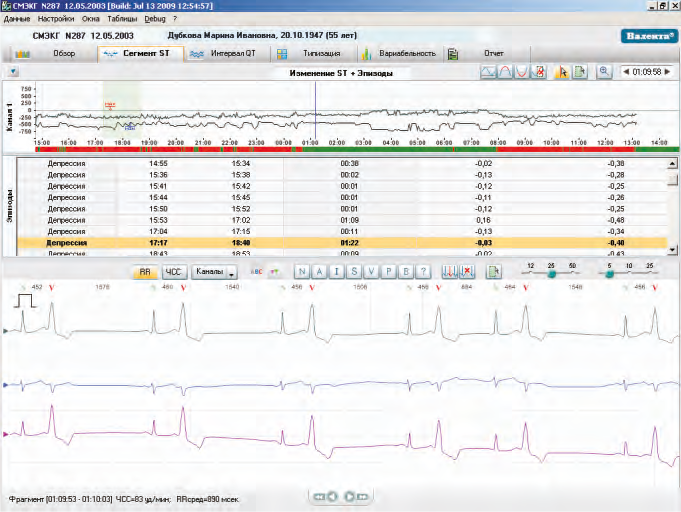 Холтер ЭКГ Валента 12-ти канальный Santreyd MED-37 - Вид №4