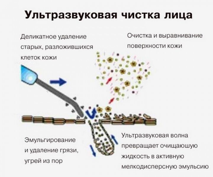 30719 Аппарат для ультразвуковой чистки лица Bio Sonic 770 Beauty Star  - Вид №6